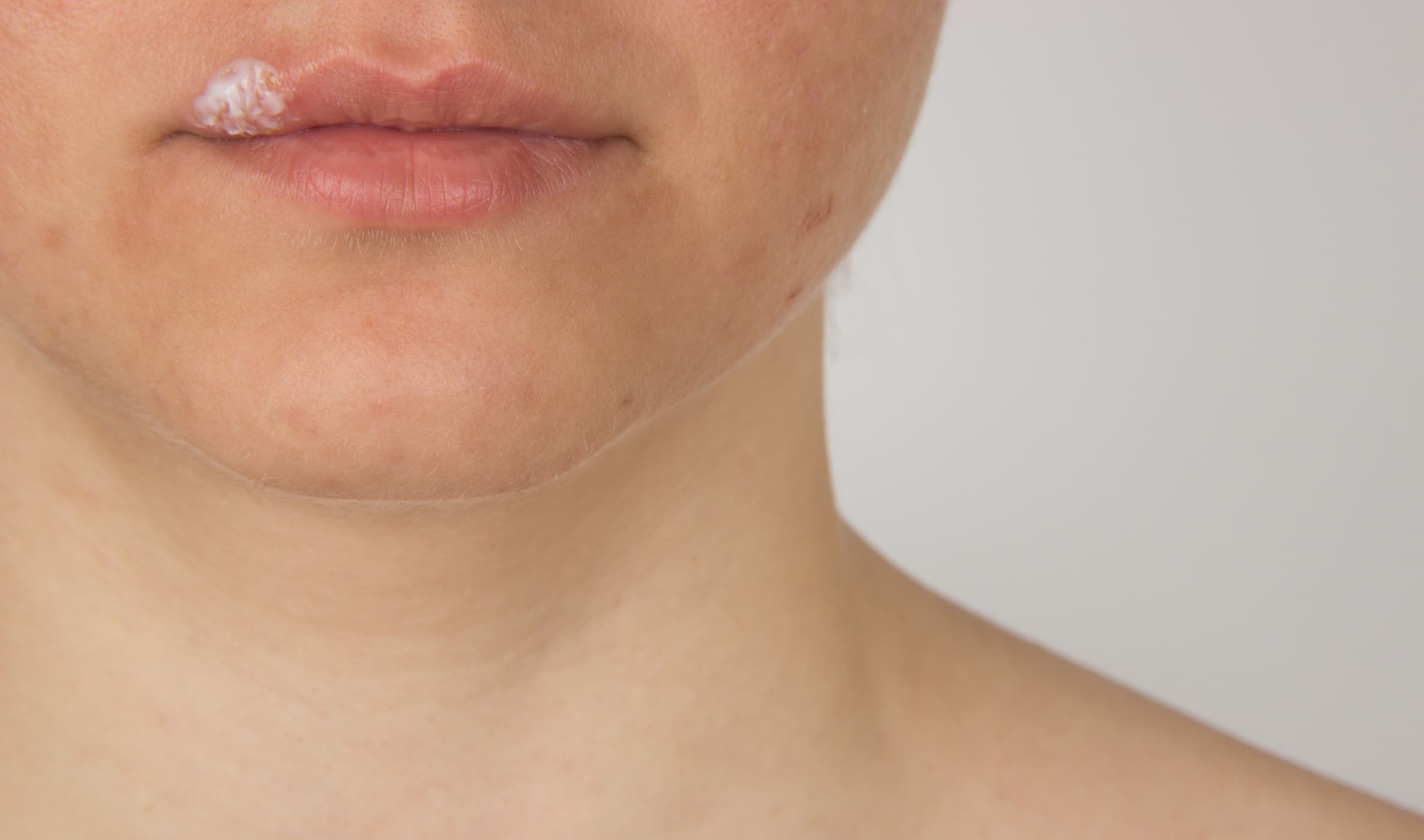 Điều trị sẹo trên môi do Herpes, bệnh mụn rộp môi