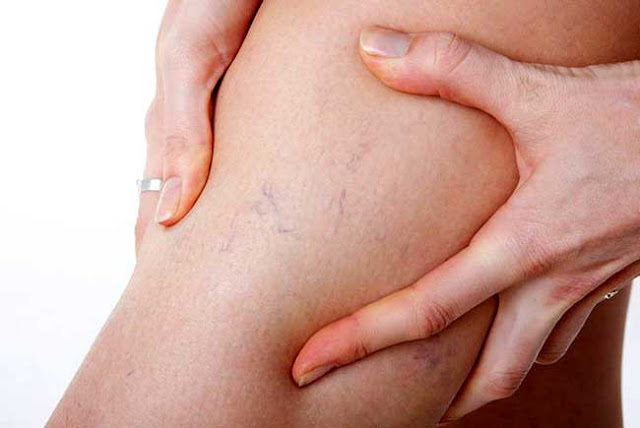 Lời khuyên cho người mắc bệnh suy tĩnh mạch