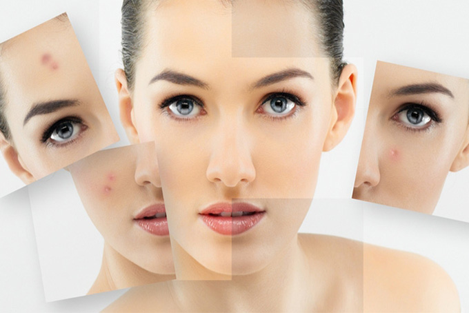 Sau khi phi kim trị mụn thì phải tuân thủ chế độ sinh hoạt như thế nào?