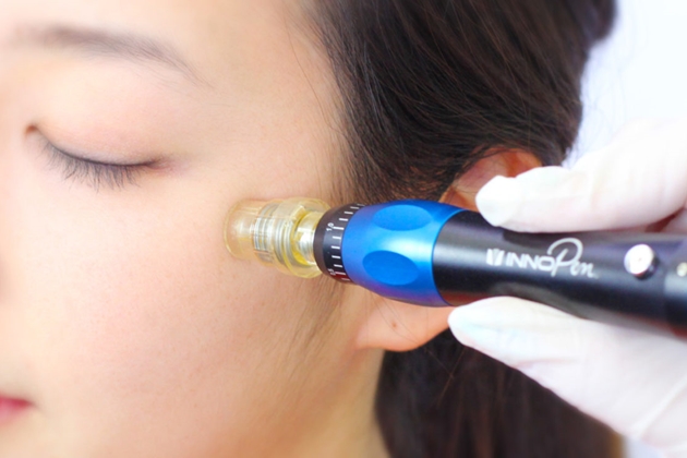 Phương pháp phi kim trị mụn là gì? Ưu điểm của phương pháp này ra sao?