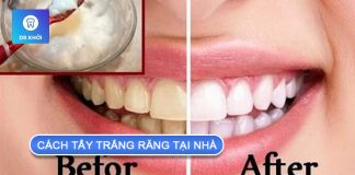 Tìm hiểu cách tẩy trắng răng tại nhà an toàn cách tẩy trắng răng tại nhà