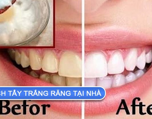 Tìm hiểu cách tẩy trắng răng tại nhà an toàn cách tẩy trắng răng tại nhà