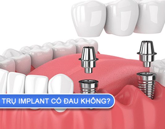 Quá trình cắm trụ implant có đau không? cắm trụ implant có đau không