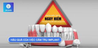 Hậu quả của việc cắm trụ implant không đúng kỹ thuật hậu quả của việc cắm trụ implant