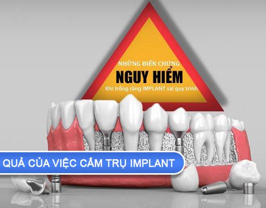 Hậu quả của việc cắm trụ implant không đúng kỹ thuật hậu quả của việc cắm trụ implant
