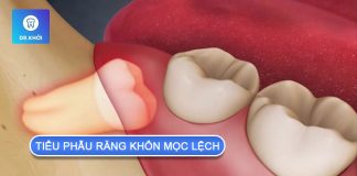 Tầm quan trọng của tiểu phẫu răng khôn mọc lệch tiểu phẫu răng khôn mọc lệch