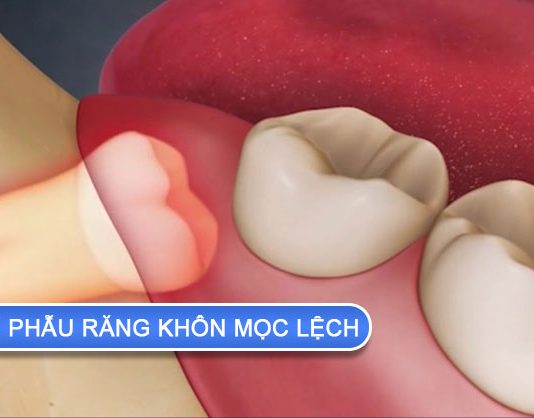 Tầm quan trọng của tiểu phẫu răng khôn mọc lệch tiểu phẫu răng khôn mọc lệch