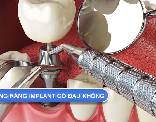 Thực hiện quy trình trồng răng implant có đau không? trồng răng implant có đau không