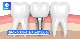 Trồng răng implant là gì? Giải đáp thắc mắc của khách hàng trồng răng implant là gì