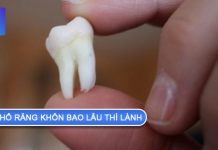 Nhổ răng khôn bao lâu thì lành? Lưu ý sau khi nhổ răng nhổ răng khôn bao lâu thì lành