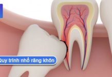 Quy trình nhổ răng khôn số 8 không đau và an toàn quy trình nhổ răng khôn