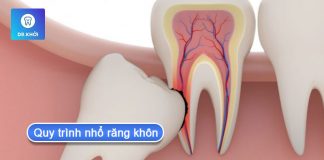Quy trình nhổ răng khôn số 8 không đau và an toàn quy trình nhổ răng khôn