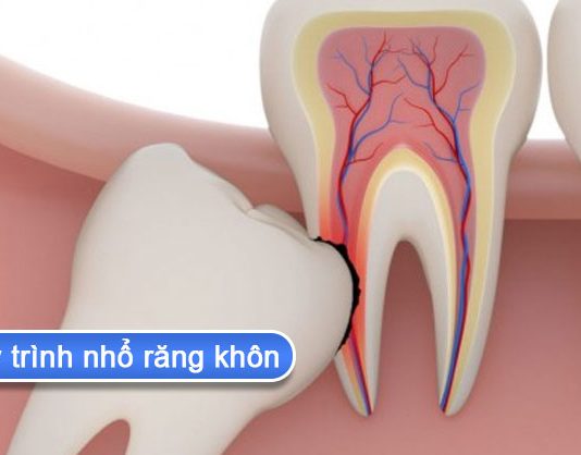 Quy trình nhổ răng khôn số 8 không đau và an toàn quy trình nhổ răng khôn