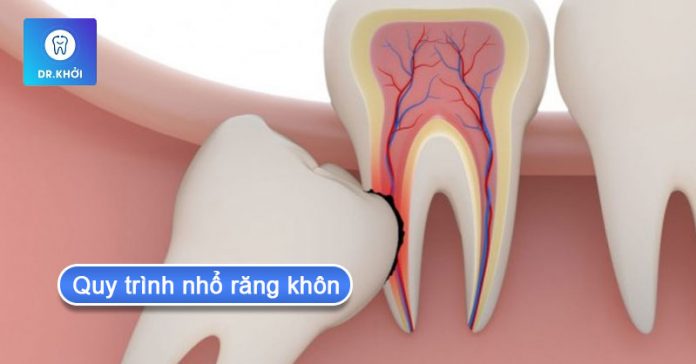 quy trình nhổ răng khôn quy trình nhổ răng khôn
