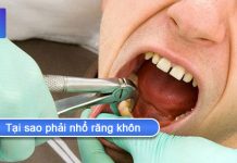 Tại sao phải nhổ răng khôn và khi nào không nên nhổ? tại sao phải nhổ răng khôn