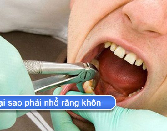 Tại sao phải nhổ răng khôn và khi nào không nên nhổ? tại sao phải nhổ răng khôn