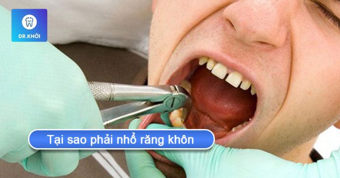 tại sao phải nhổ răng khôn tại sao phải nhổ răng khôn